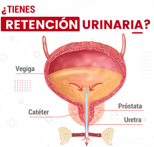 Que es la retención urinaria.