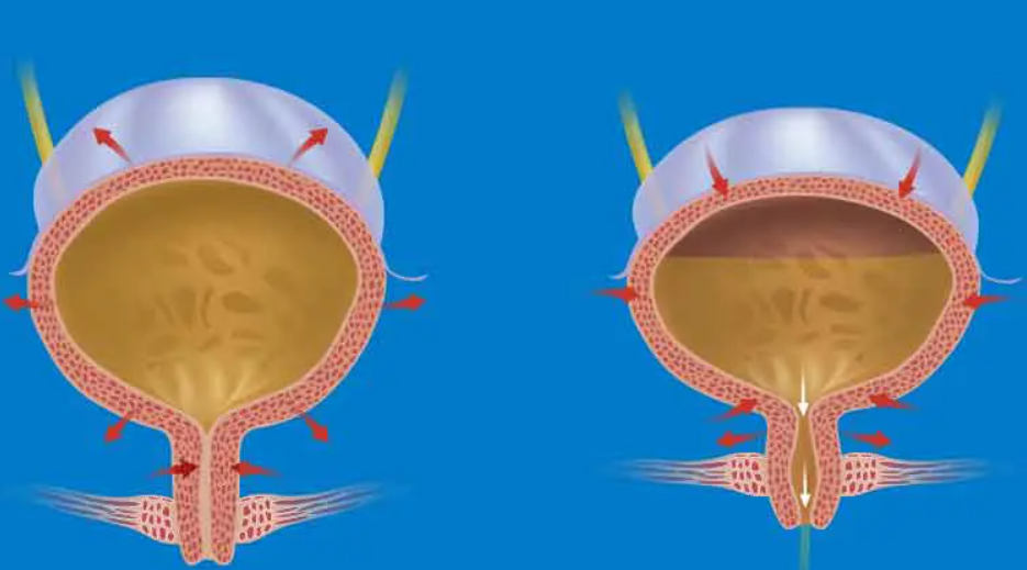 Que es la vejiga neurogénica ?